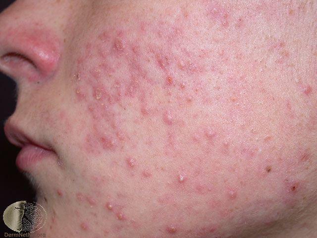 acne1.jpg